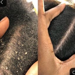 Nizoral Anti-Dandruff Shampoo 2% Ketoconazole