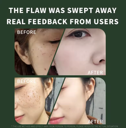 Skin Tag Remover *Professional Use*