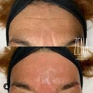 Zena Hyalnano Filling 2 vial set