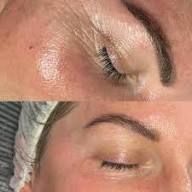 Zena Hyalnano Filling 2 vial set