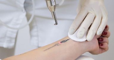 Tattoo Removal 