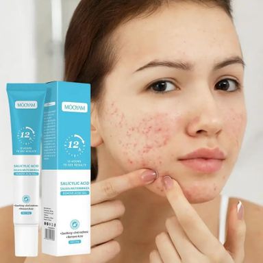 Mooyam Acne treatment gel