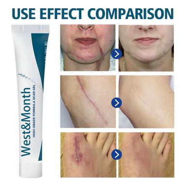 WEST AND MONTH SCAR REMOVAL CREAM