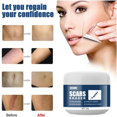 eelhoe skin repair cream lightening scar gel cream burns burns pox marks lightening smooth skin scar gel cream 30g 