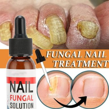 Nail fungal solution