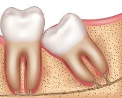 Impacted Wisdom Tooth