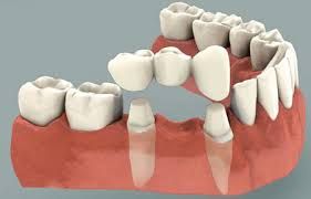 Tooth Replacement (Consult first)