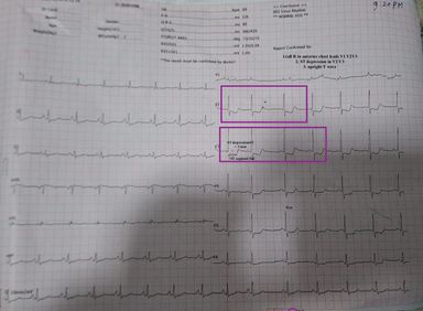 ECG