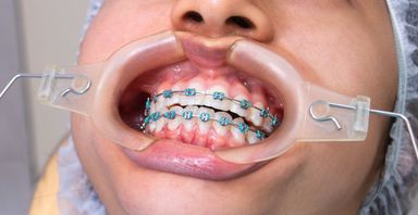 Braces (Orthodontie)