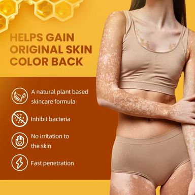 New Bee Venom Vitiligo Removal Cream