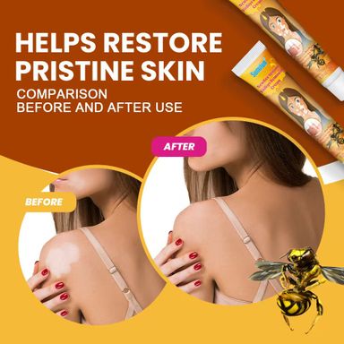 New Bee Venom Vitiligo Removal Cream