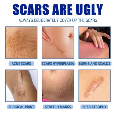 JaySuing Scar Removal Cream – Fade Scars, Stretch Marks & Acne