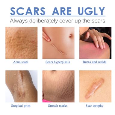 Scar Improvement Tape - Six Advantages for Scar Healing