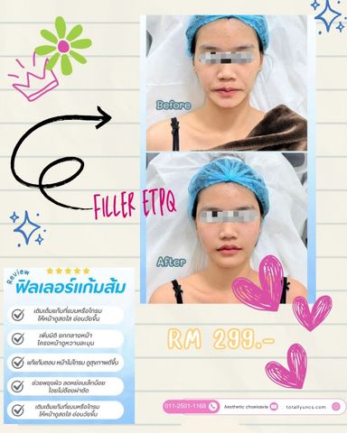 Review 🩷💉Filler แก้มส้ม ทำให้ดูเด็ก ละมุนอ่อนเยาว์👶🏻