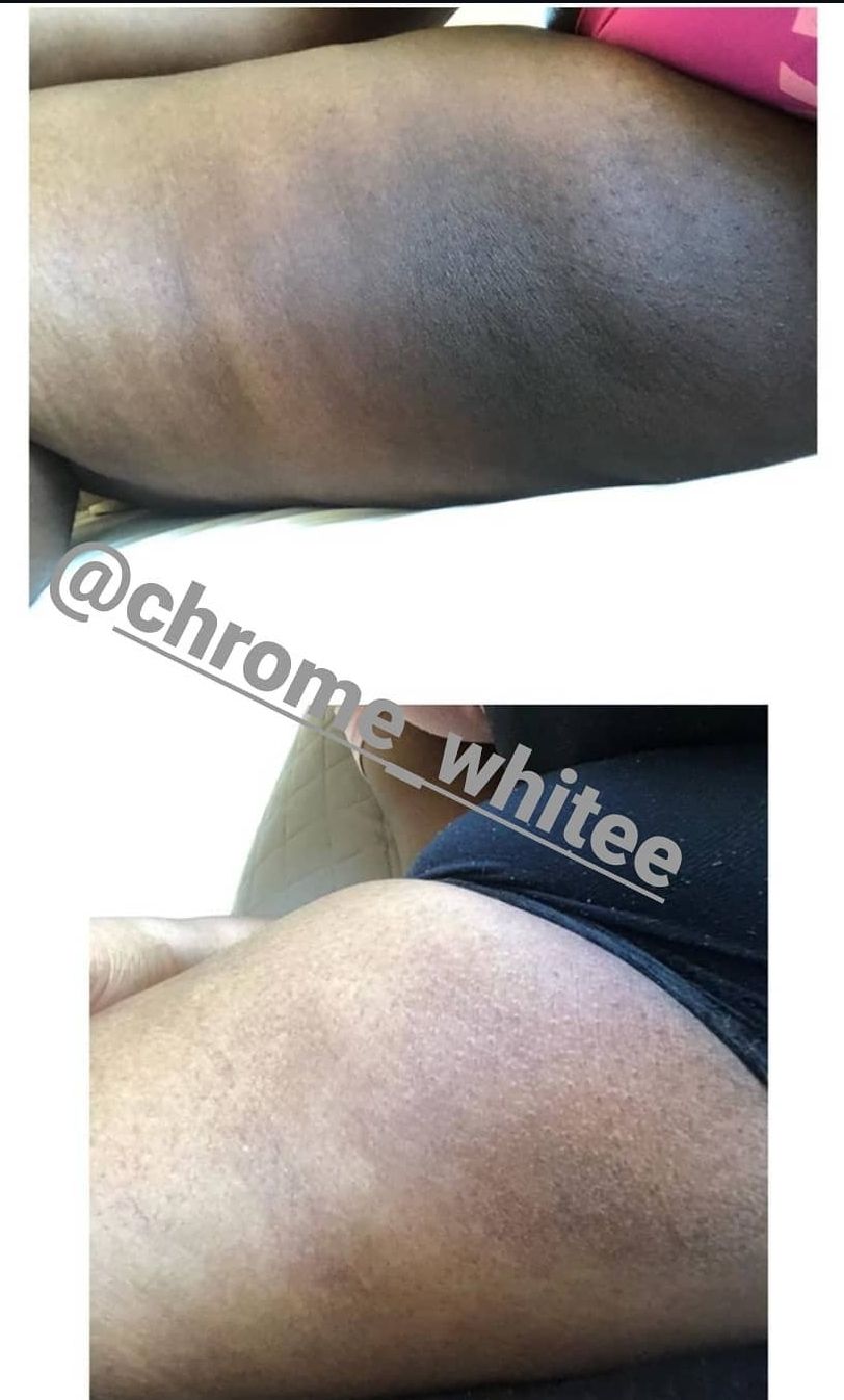 Dark inner thighs, dark neck and dark under arms remover products 