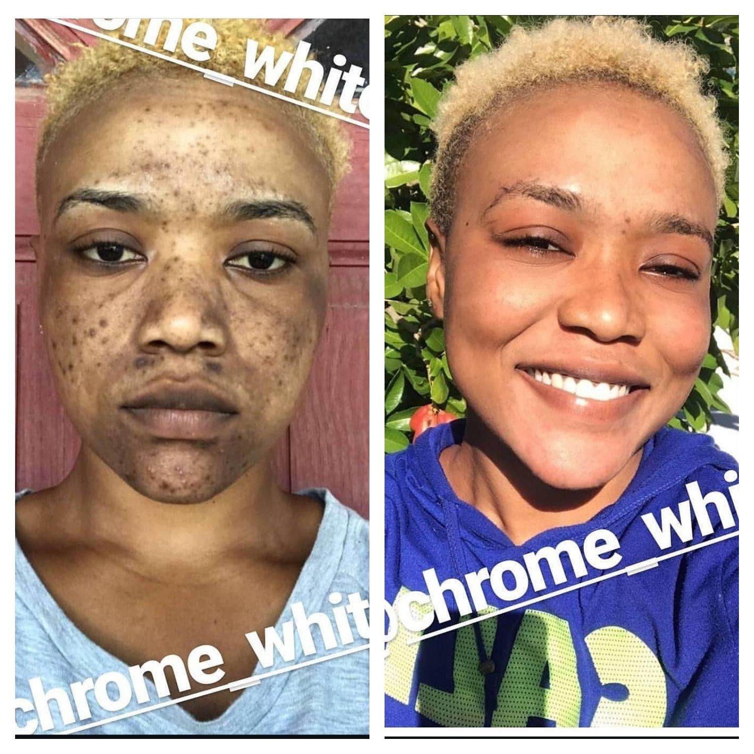 Dark spot, acne ,blemishes ,white heads ,hyperpigmentation, psoriasis products 
