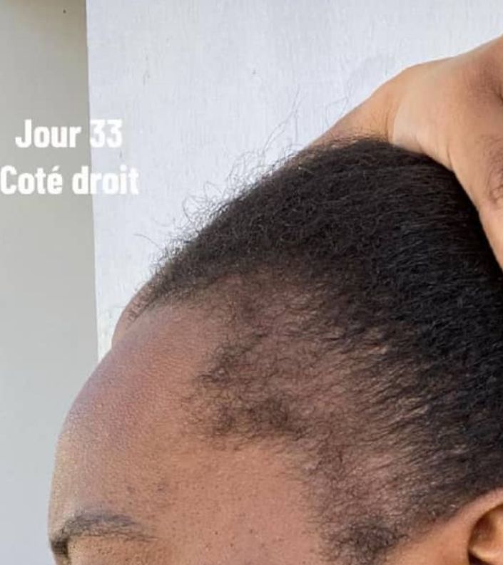 Traitement capillaire_5